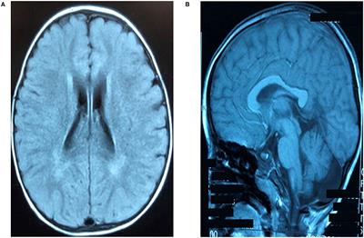Case Report: A Novel de novo Mutation in DNM1L Presenting With Developmental Delay, Ataxia, and Peripheral Neuropathy